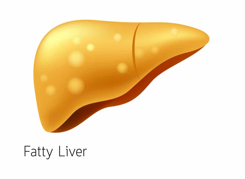 Fatty Liver