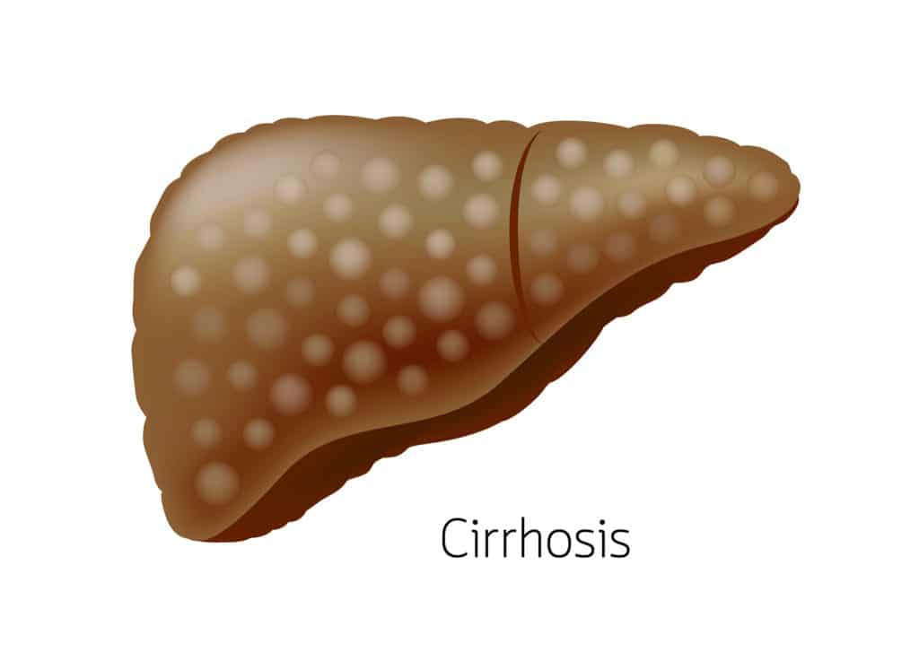 Liver Cirrhosis