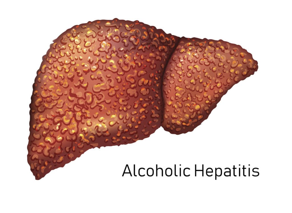 Liver Hepatitus